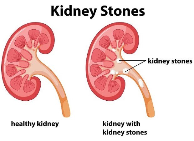 Kidney Stones